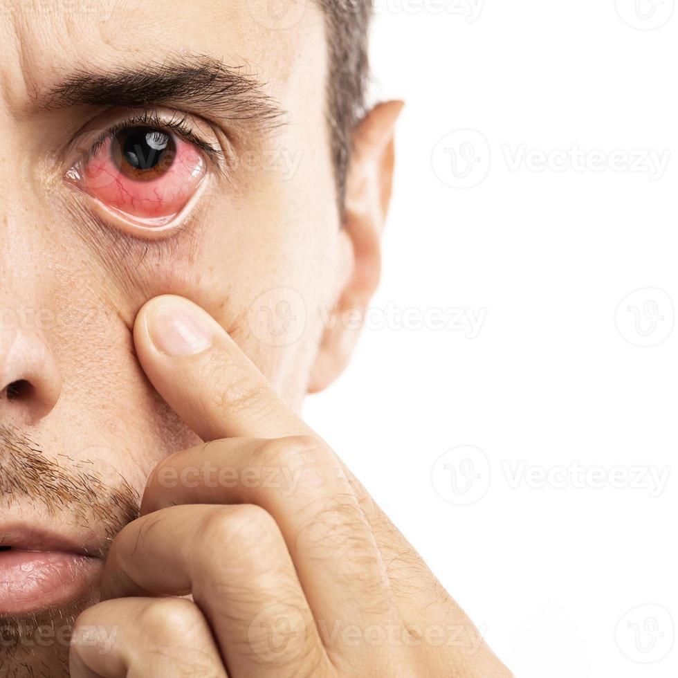 Man with the Subconjunctival hemorrhage in his eye photo