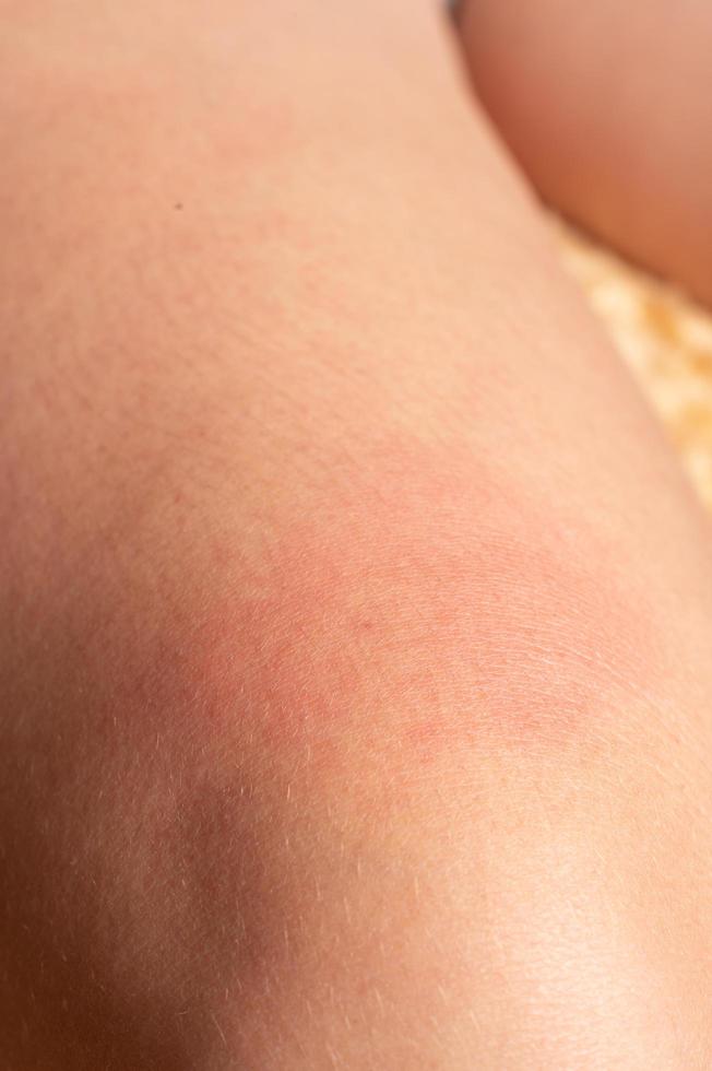 Allergy on the human body and redness from a wasp sting. photo