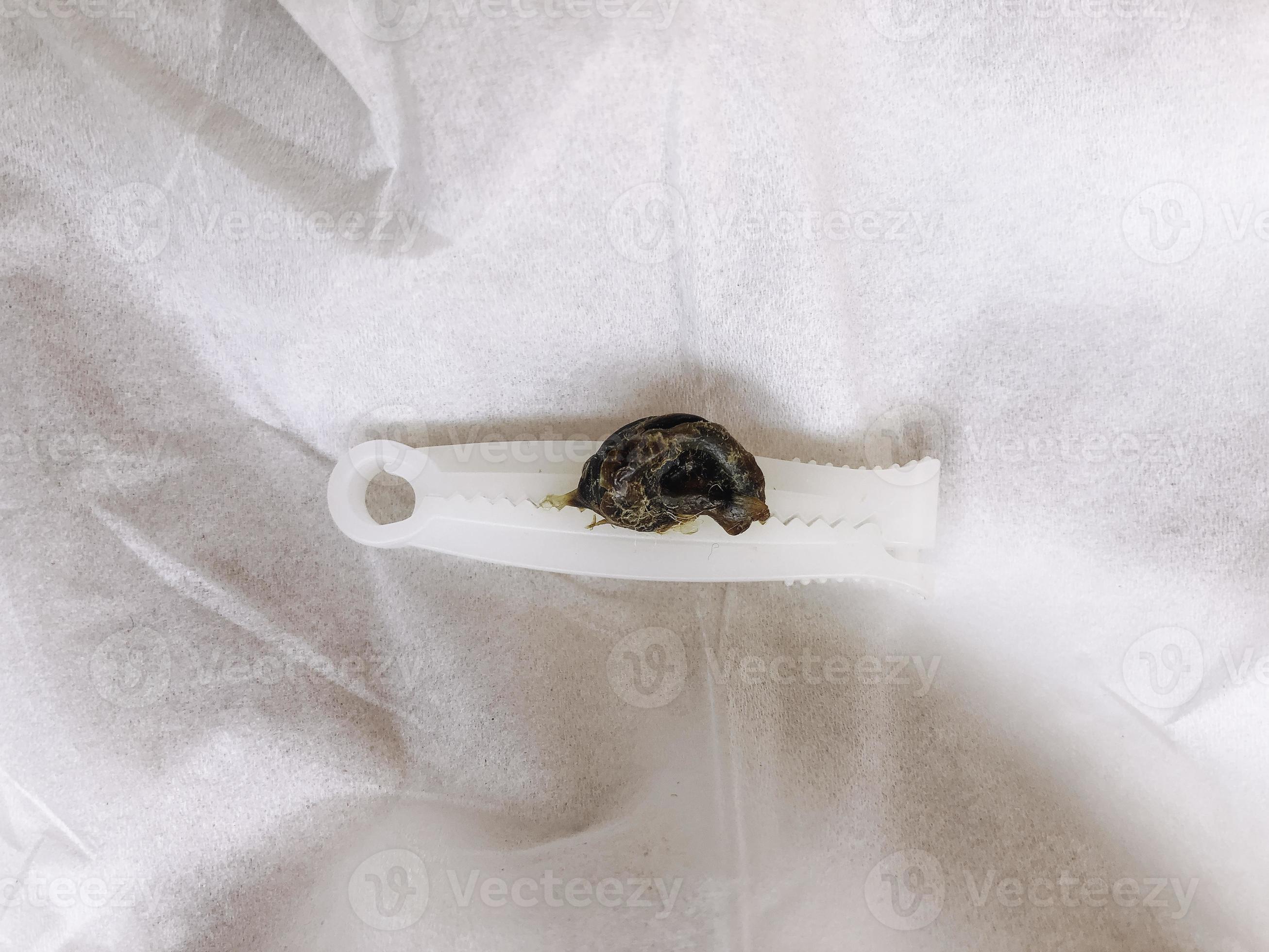 Dried Umbilical cord of baby girl, Umbilical cord in hand. 14378793