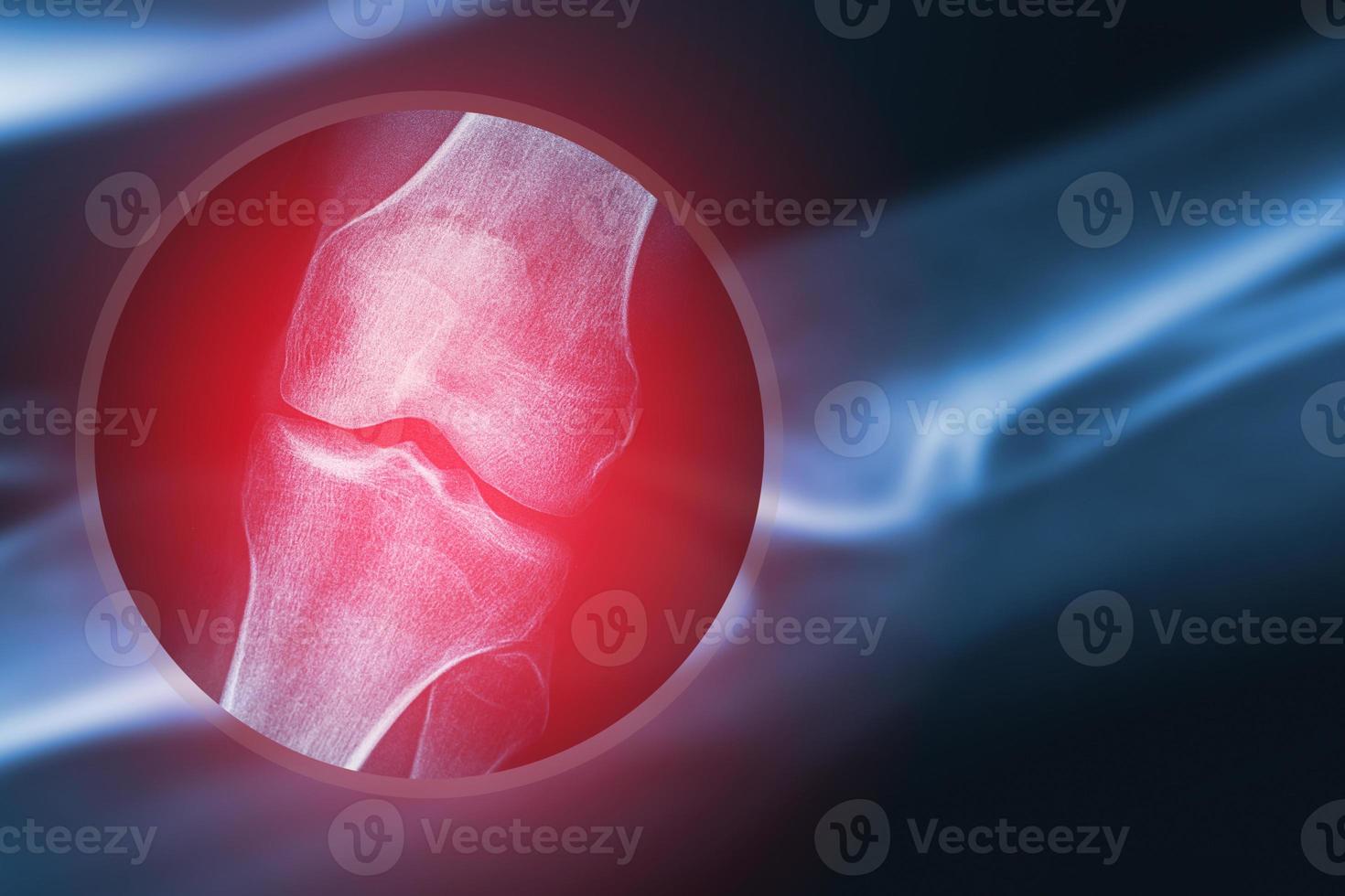 imagen de rayos x de la rodilla humana foto