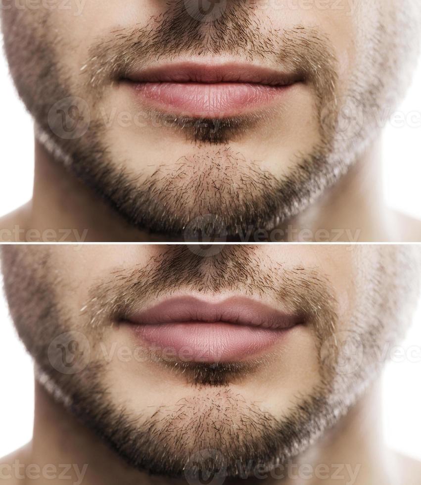 Lip augmentation. Male lips  before and after filler injection. photo