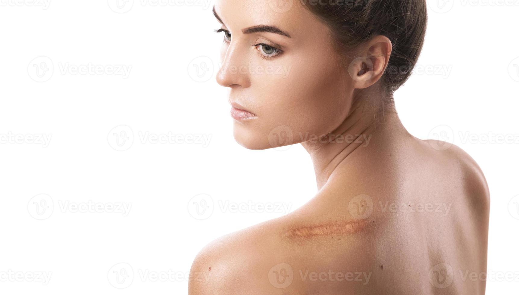 Young woman with a scar on her shoulder photo