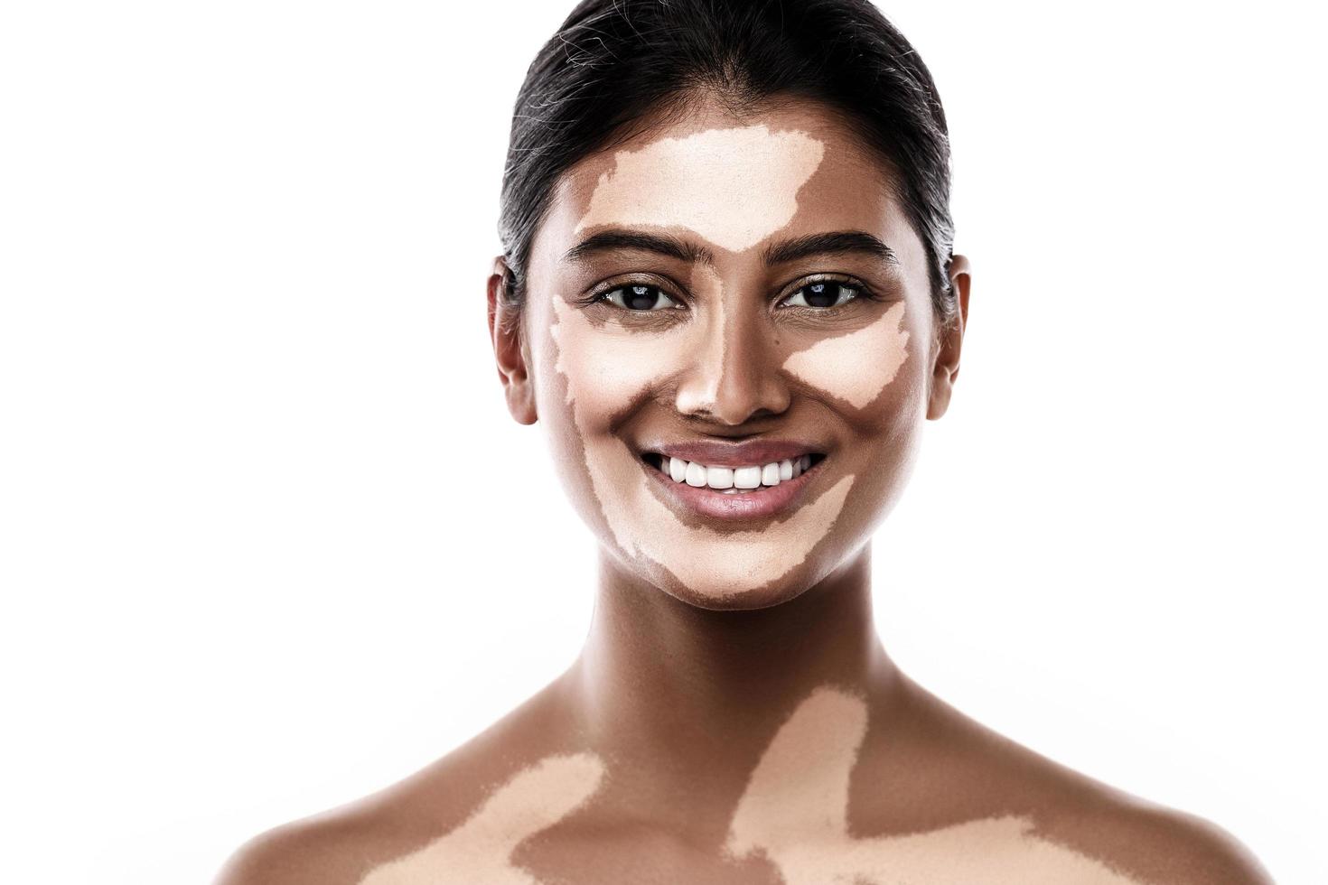 Beautiful South Asian woman with vitiligo skin disorder against white background photo