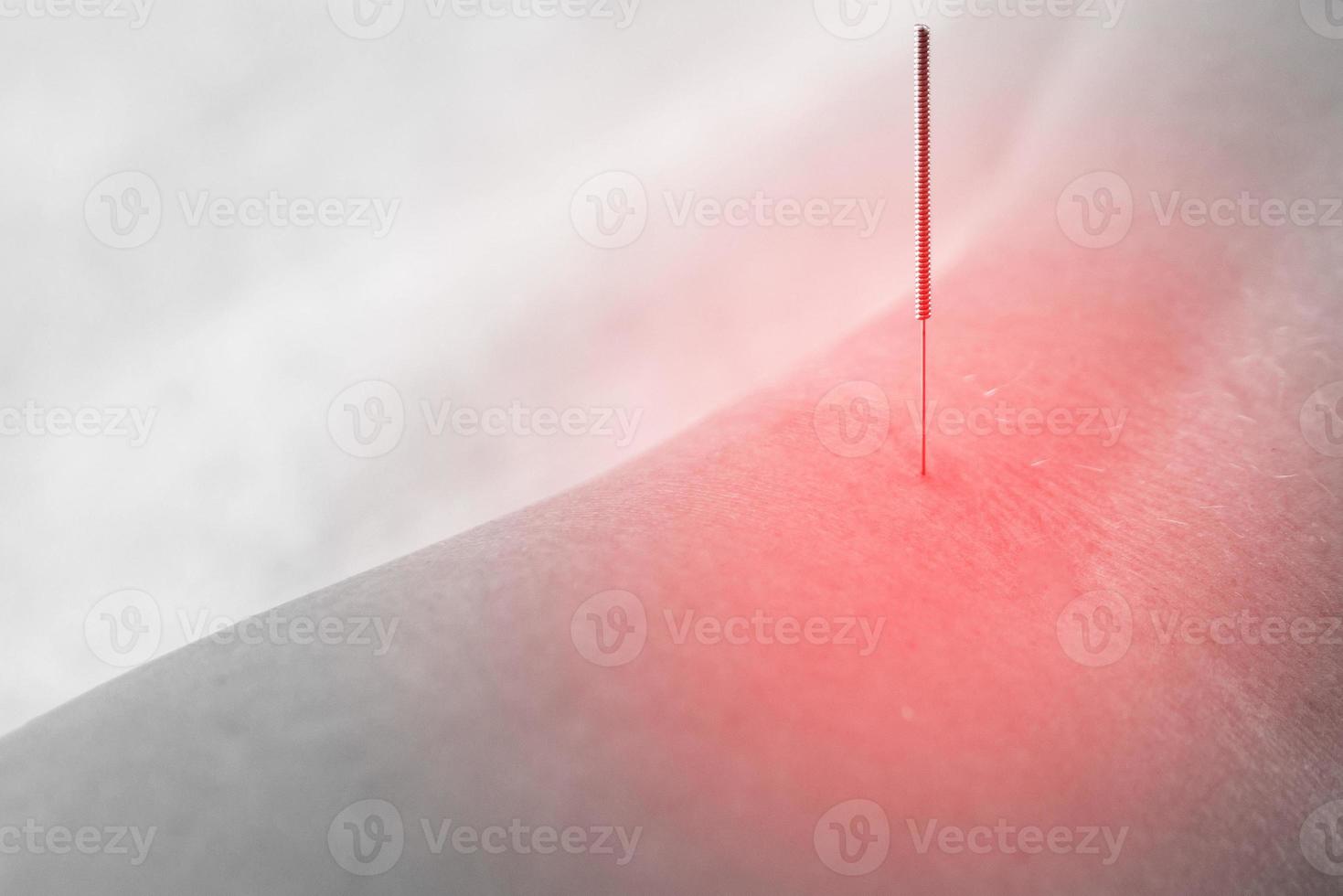 Close-up of female popliteal fossa with steel needles inserted during procedure of acupuncture therapy photo