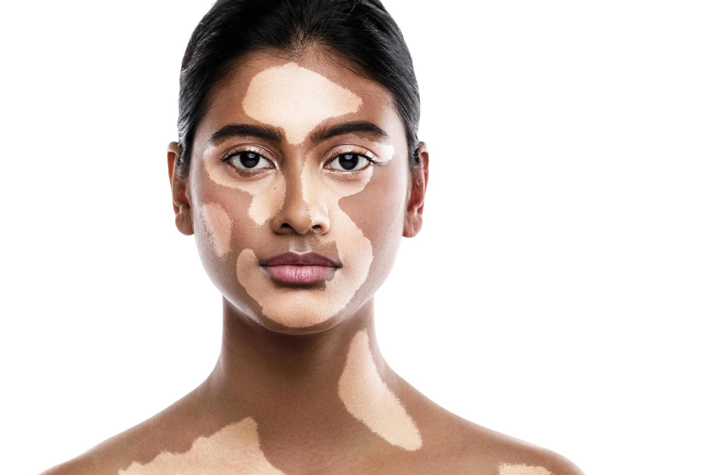 Beautiful South Asian woman with vitiligo skin disorder against white background photo