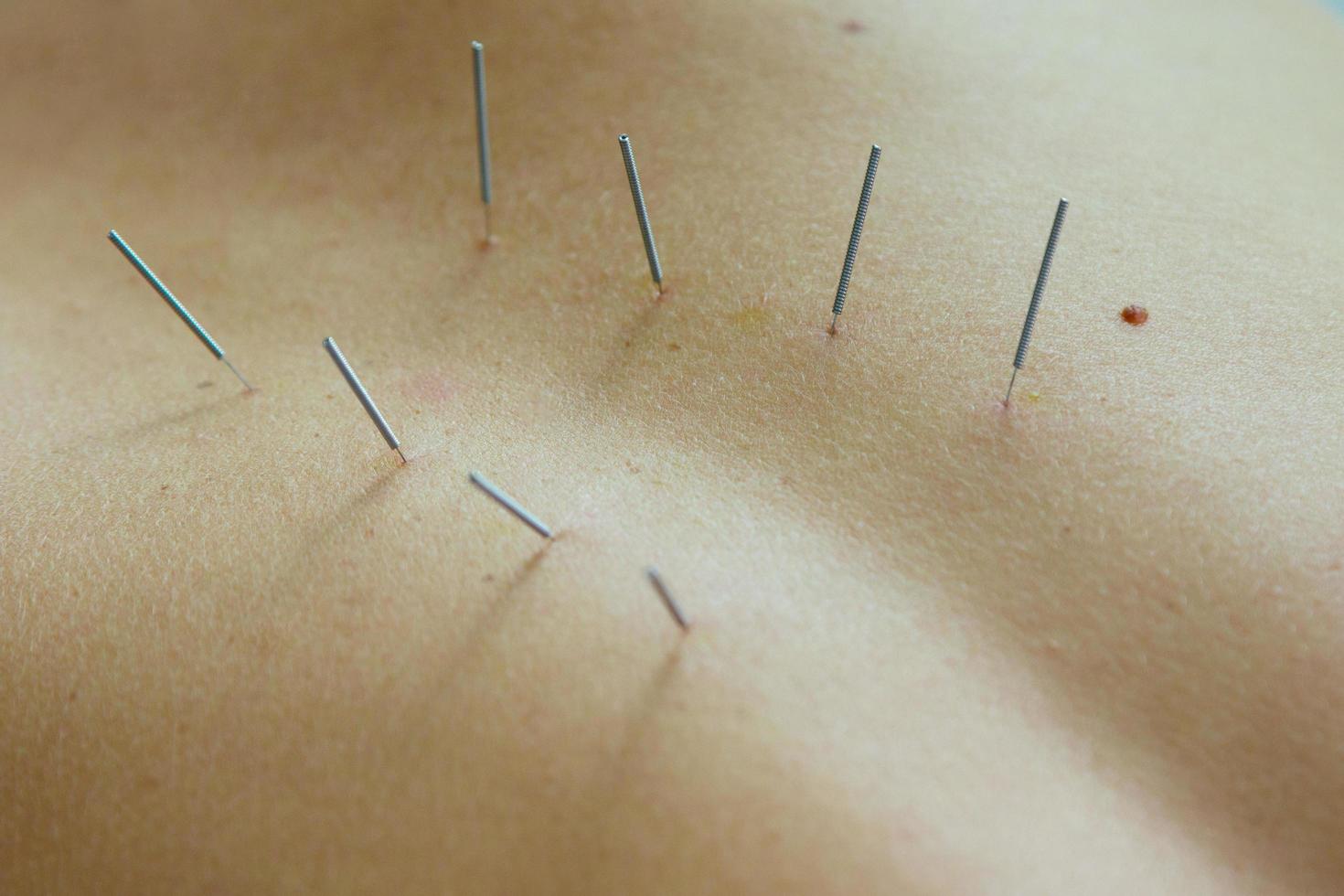 Female back with steel needles during procedure of acupuncture therapy