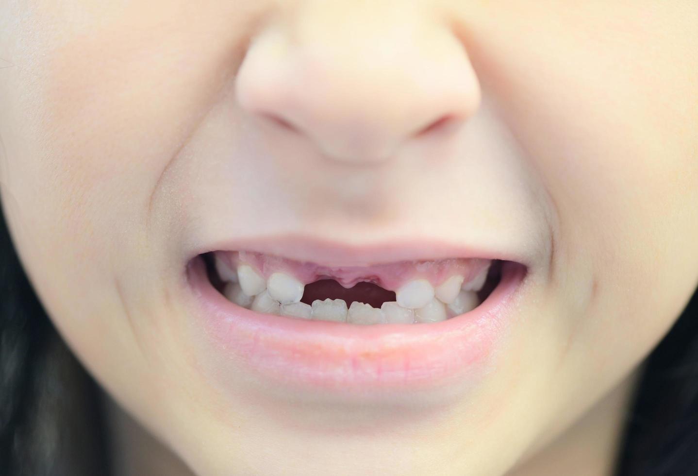 dientes de leche perdidos - diente de leche perdido, cara sonriente de una niña, dientes de leche de pérdida de dientes, su diente de leche se cayó y su diente permanente en crecimiento en el concepto de problemas de salud dental de boca abierta foto