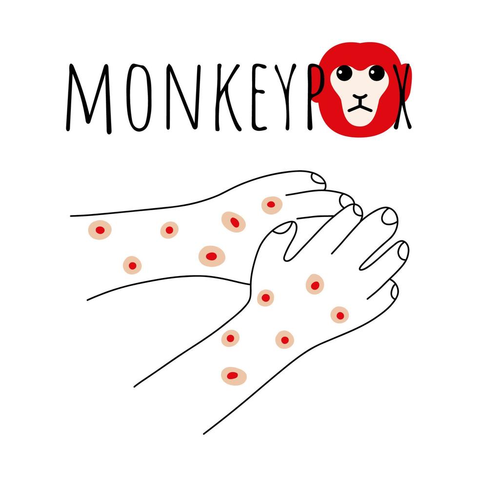 Monkeypox virus symptom doodle concept. Monkey face and hands with rash. Monkey pox script. Viral smallpox disease. Vector illustration.