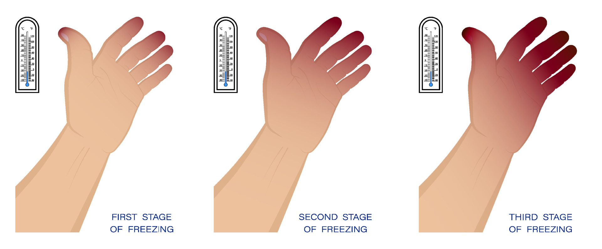 hand of man with different stages of frostbite. Freezing and skin