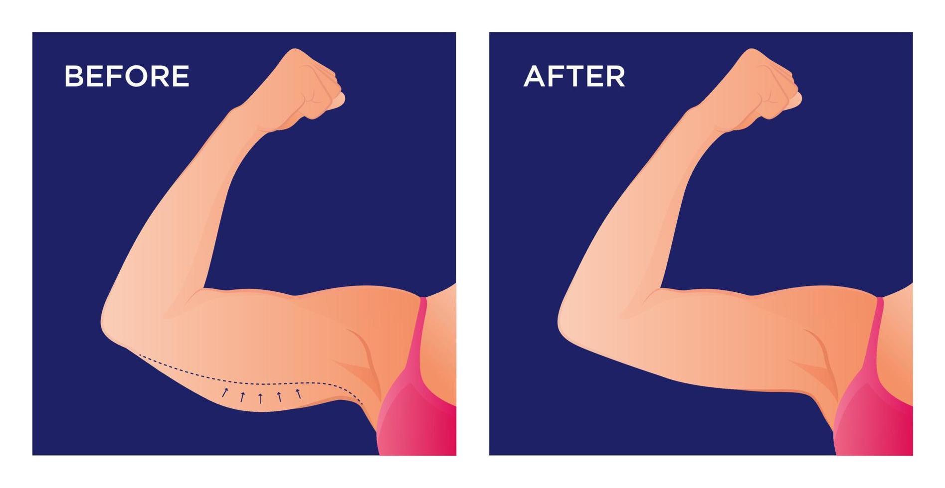 Arm with excess skin before and after surgical operation. Saggy skin removal and arm before and after toning exercises vector