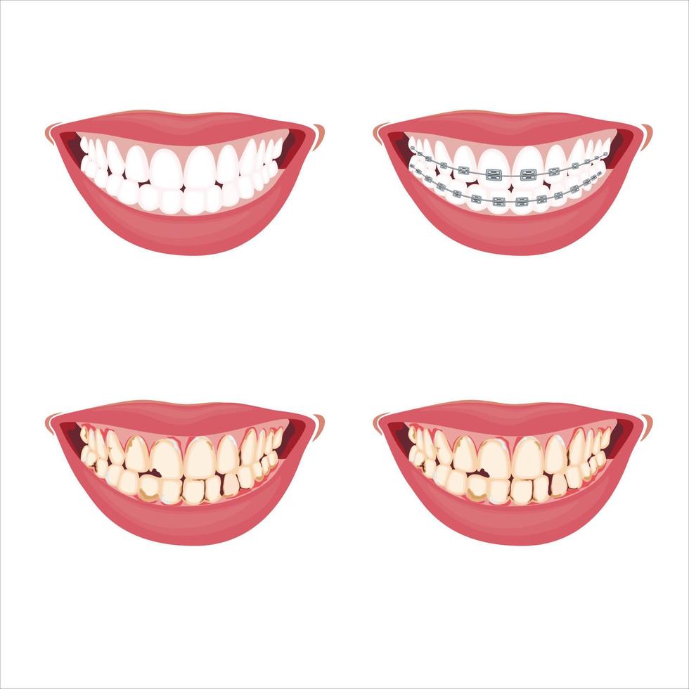 ilustración de dientes sanos y dañados, frenos dentales, dientes dañados, ilustración de vectores de dentista, cuidado oral