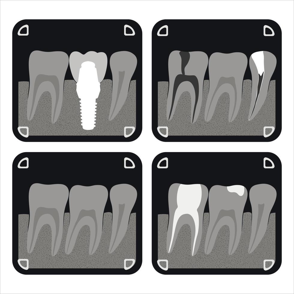 ilustración de rayos x de dientes, dientes sanos, ilustración de vector de dentista, cuidado bucal