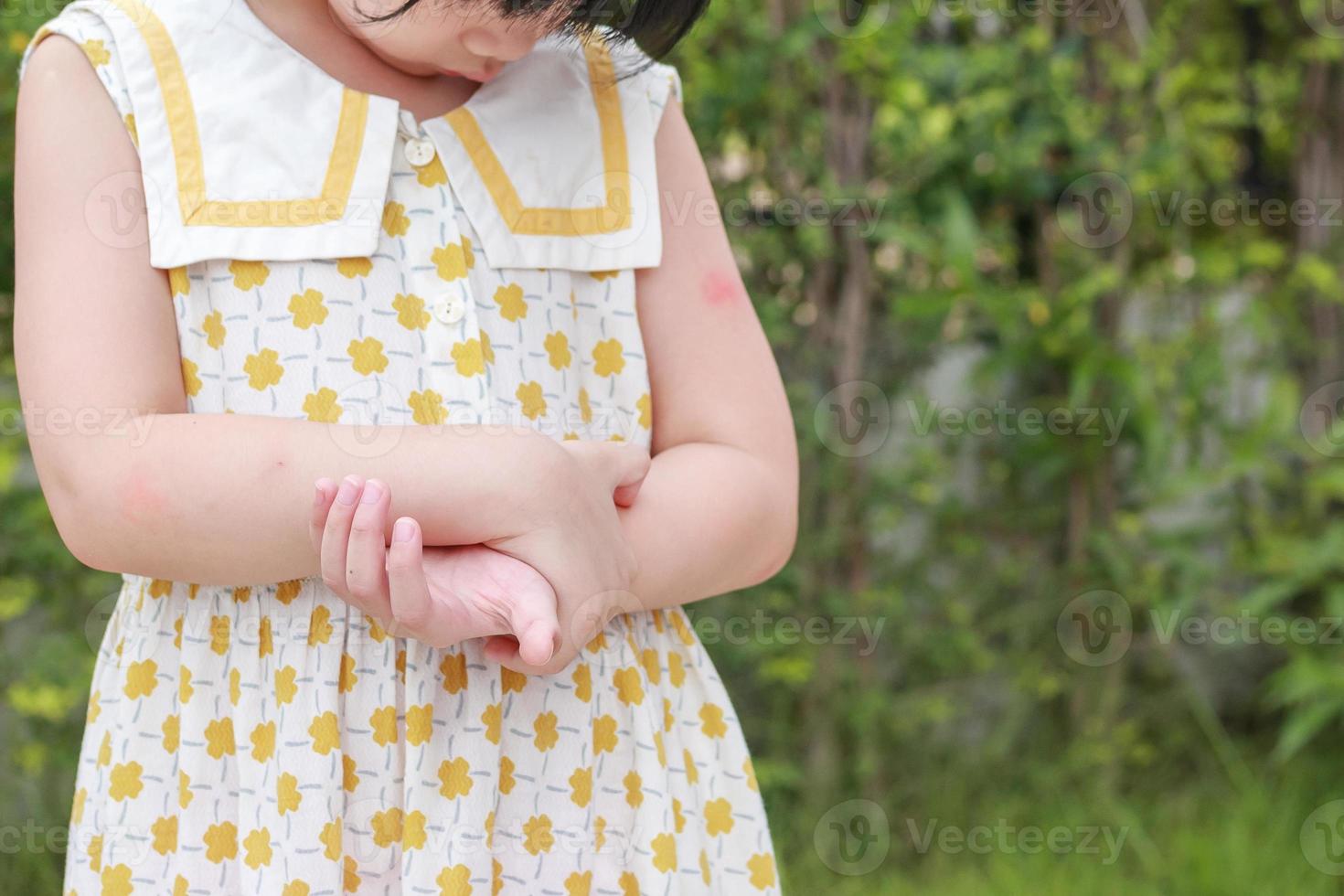 la niña tiene alergia a la erupción cutánea, picazón y rascado en el brazo foto