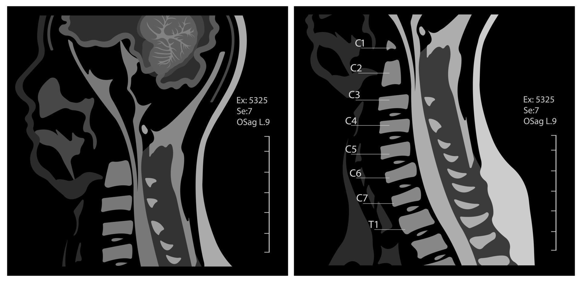 resonancia magnética de la columna cervical columna vertebral. espondilosis y compresión de la médula espinal. vector