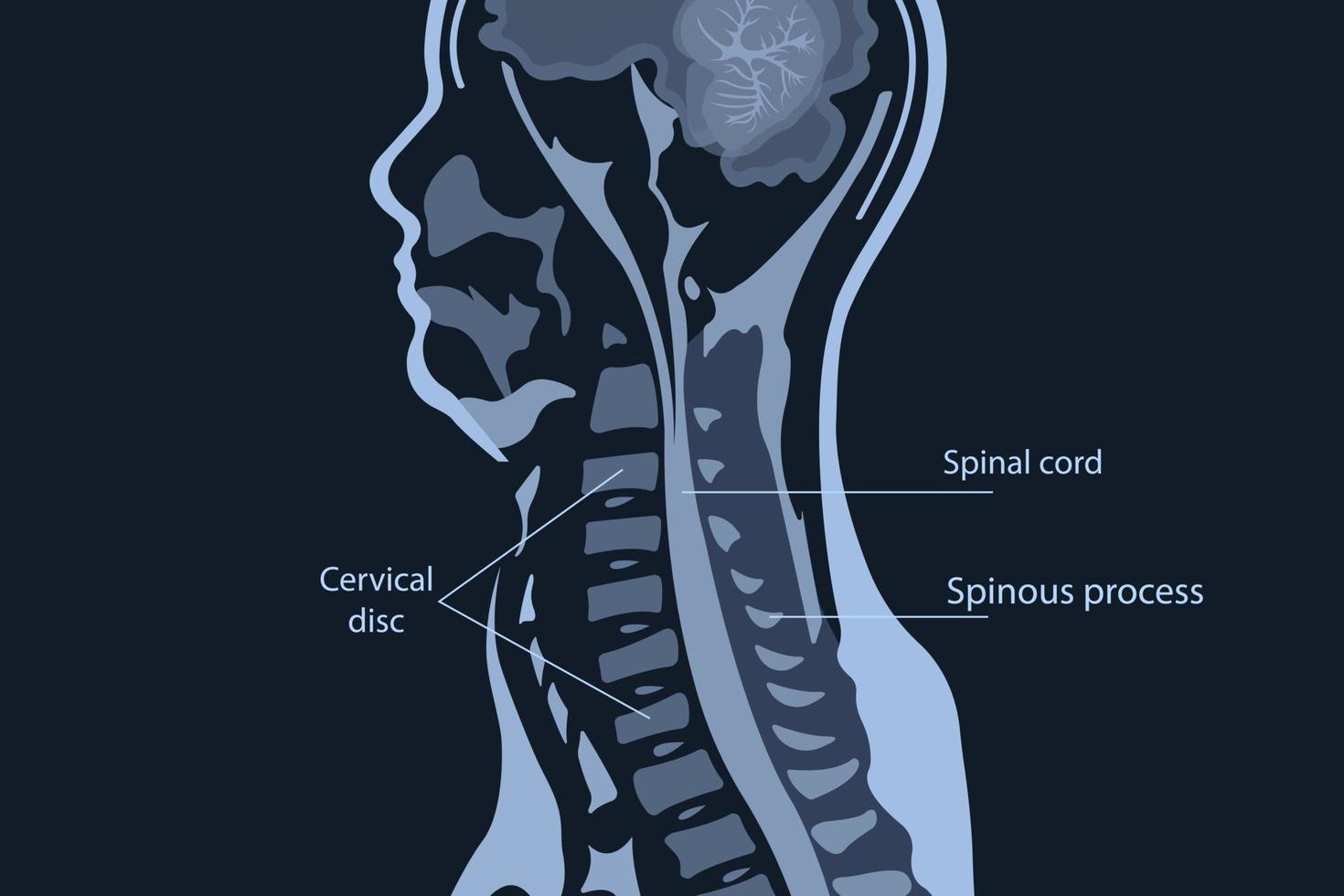 Magnetic resonance imaging of the cervical spine spine. Spondylosis and spinal cord compression. vector