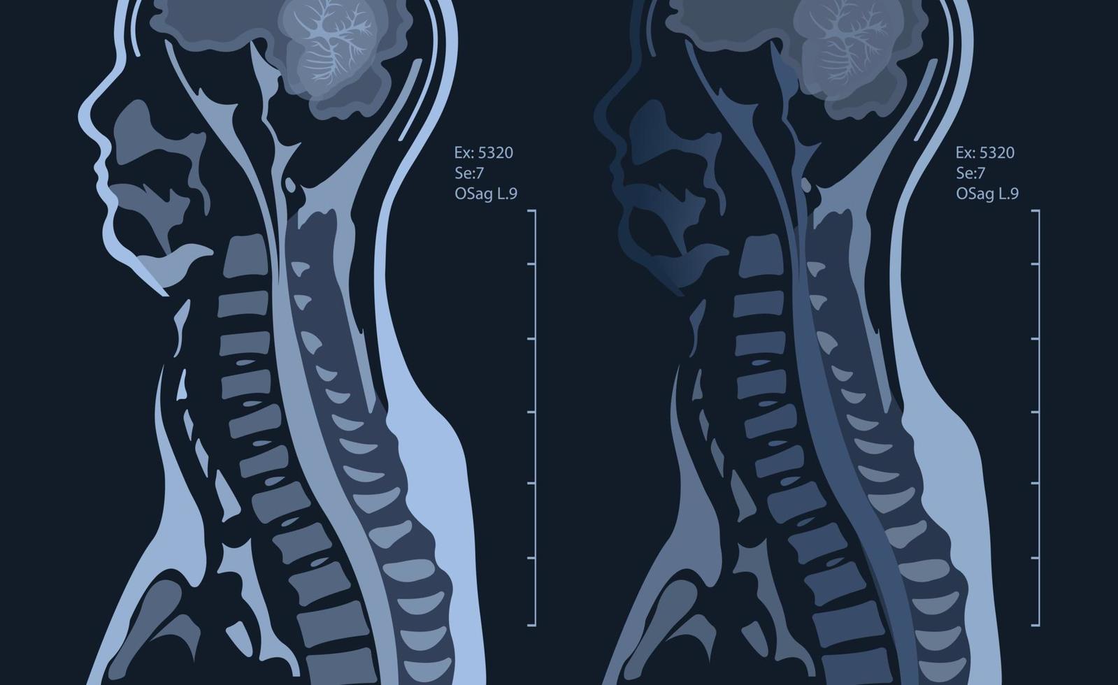 MRI of the cervical spine with and without contrast, MRI with bilateral C7 root compression, Cervical spondylosis vector