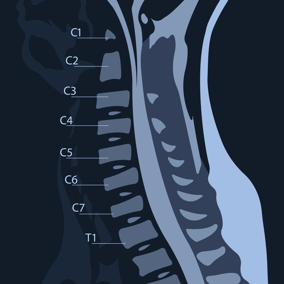 magnetic resonance image or MRI of the cervical spine in sagittal projection demonstrating cervical spondylosis and spinal cord compression. vector