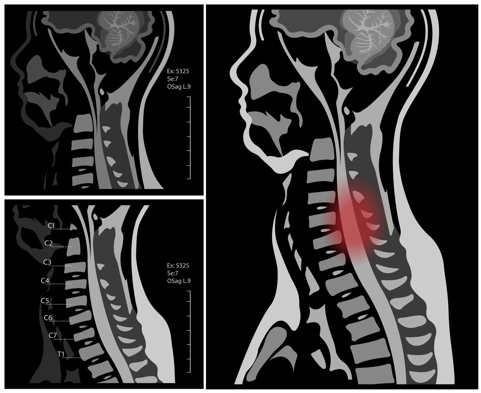 MRI of the cervical spine with and without contrast, MRI with bilateral
