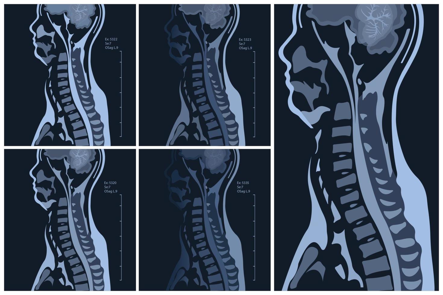 resonancia magnética de la columna cervical columna vertebral. espondilosis y compresión de la médula espinal. vector