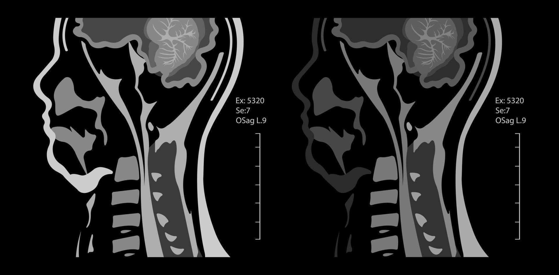 resonancia magnética de la columna cervical columna vertebral. espondilosis y compresión de la médula espinal. vector