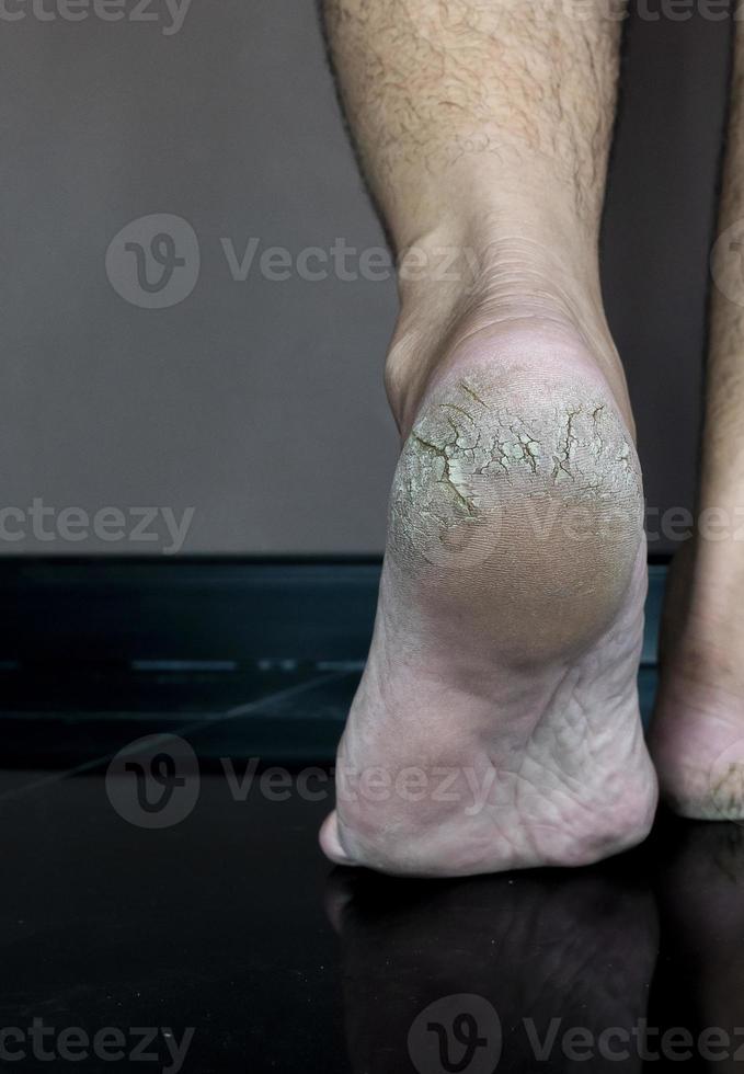 Close up cracked heel further deep cracks and dry flaky skin photo