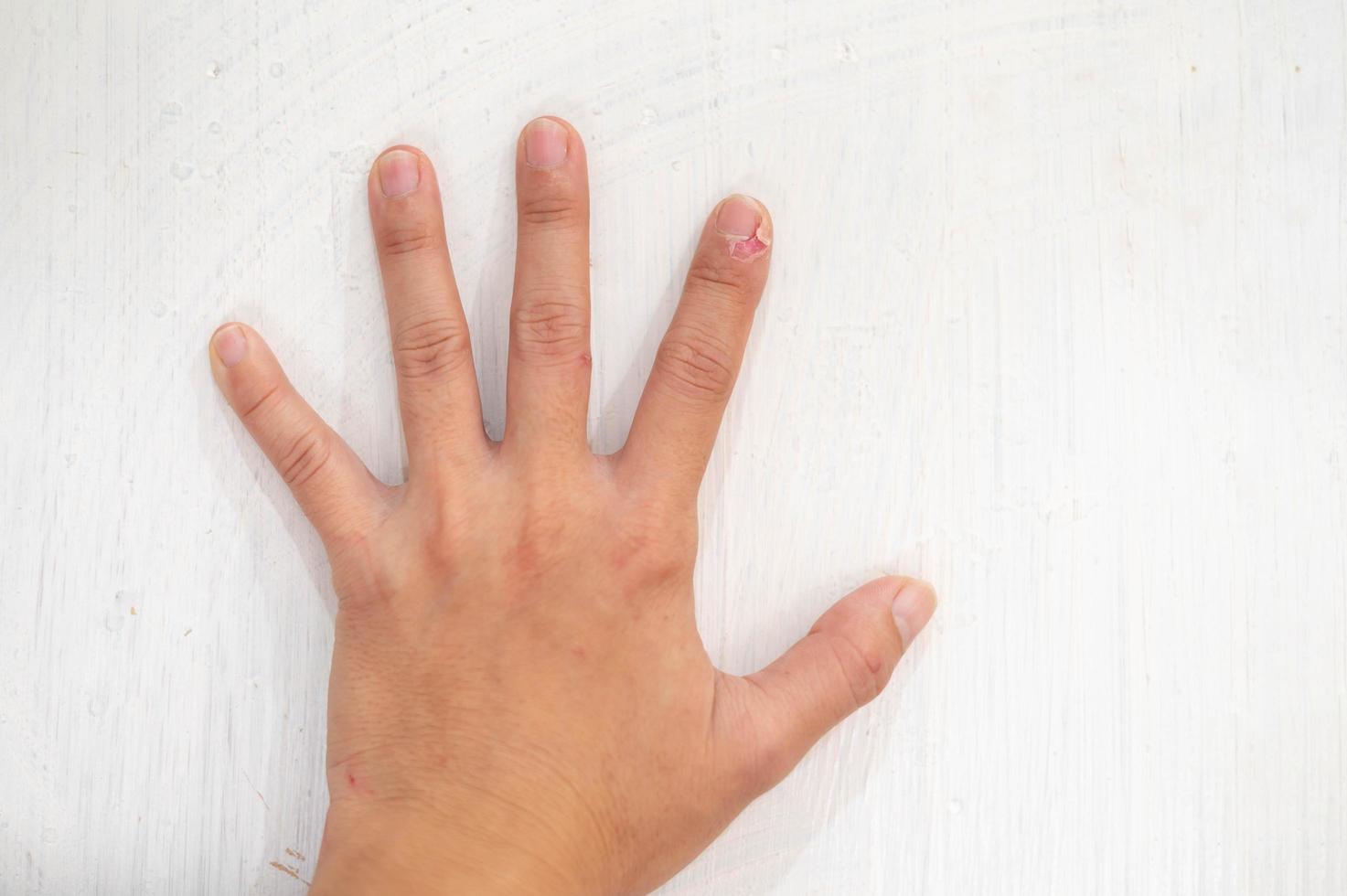 Close up of fingers female hand with dry, cracked skin on cuticles, skin is torn and flaking off should be treat with the moisturizer for repair. photo