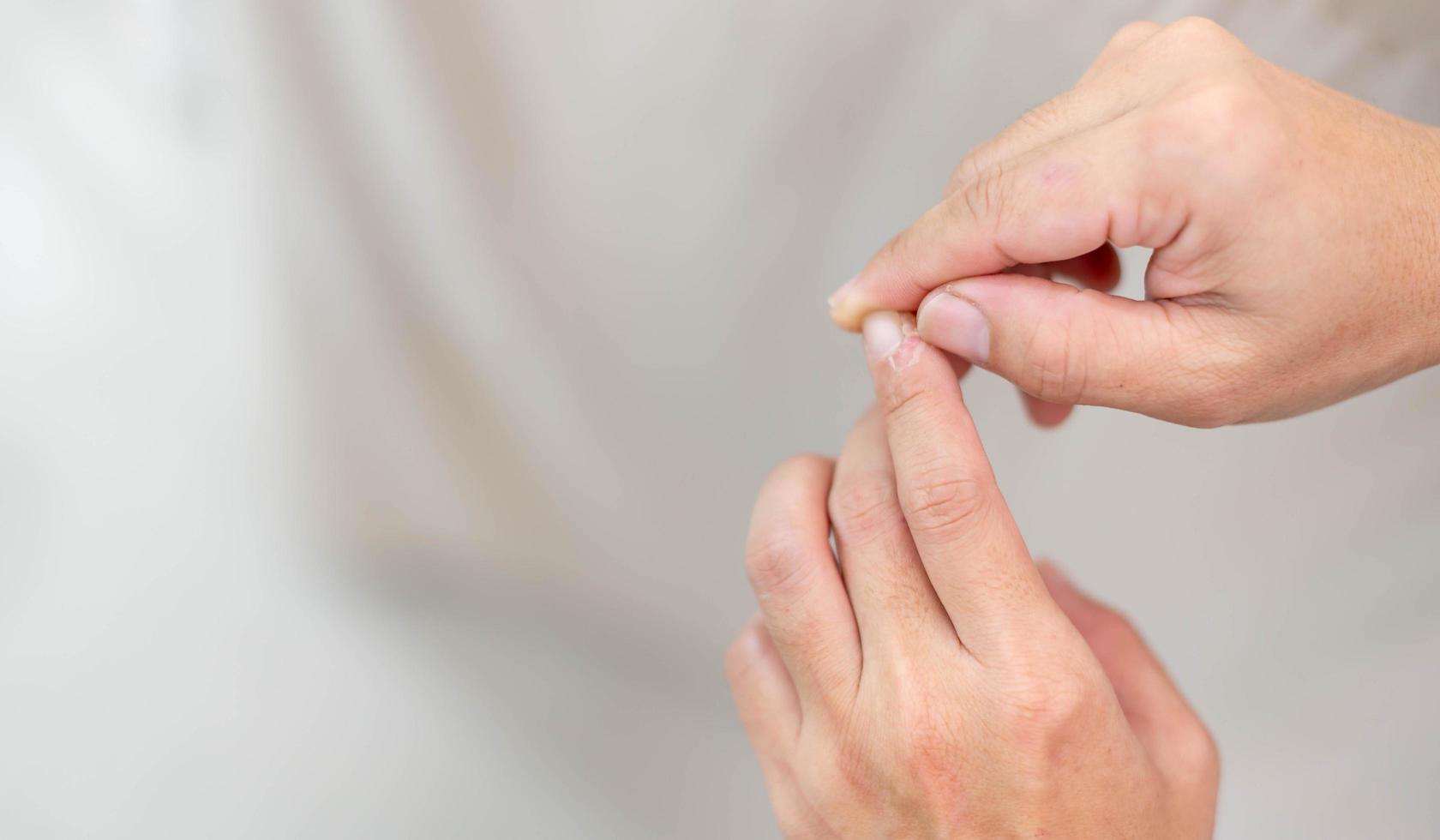 Female hand pointing to dry, cracked skin on cuticles, skin is torn and flaking off should be treat with the moisturizer for repair. photo