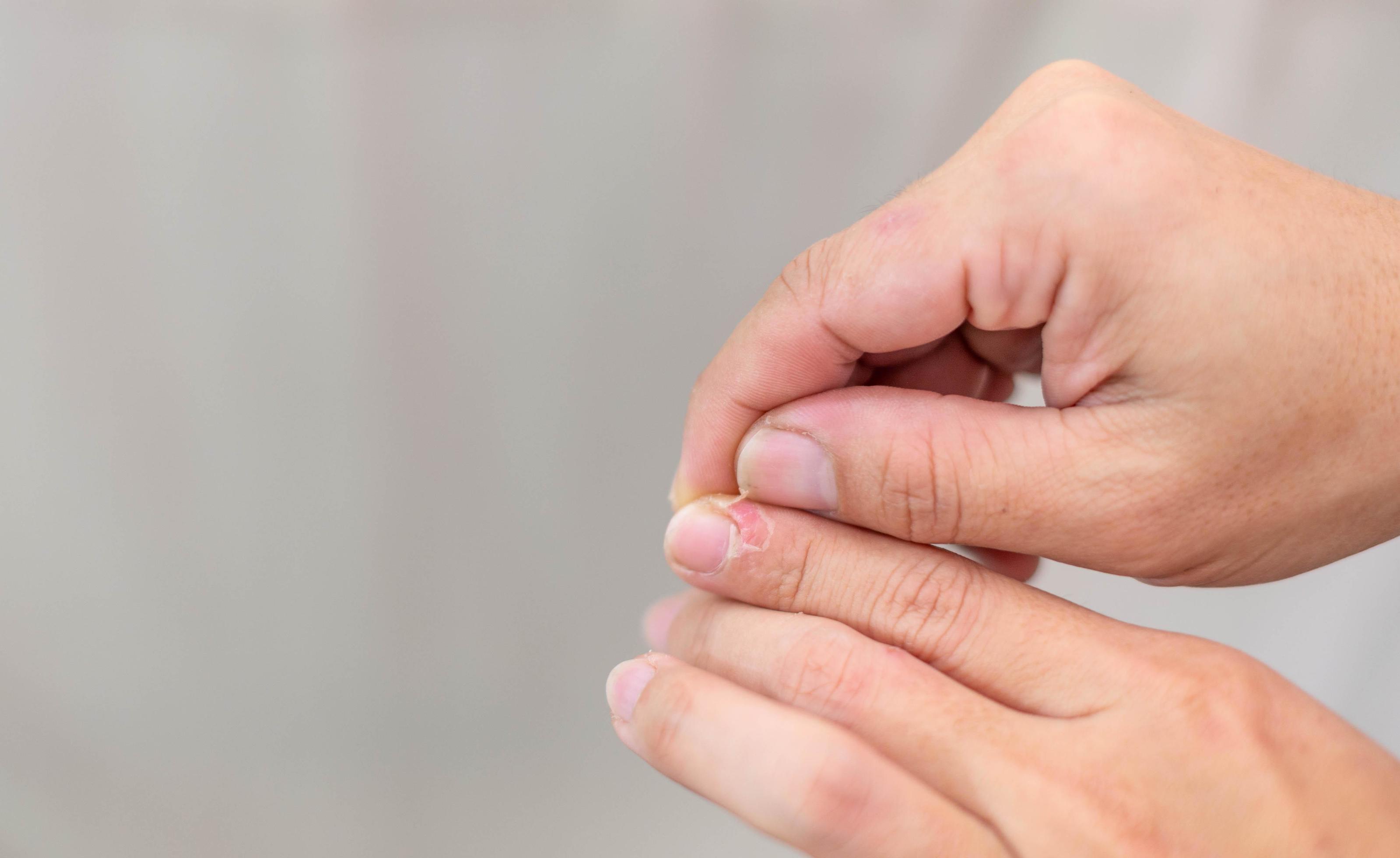 Female hand torning dry, cracked skin on cuticles, skin is torn and flaking off should be treat with the moisturizer for repair. 14753082 Stock Photo at Vecteezy Female hand torning dry, cracked skin on cuticles, skin is torn and flaking off should be treat with the moisturizer for repair. 14753082 Stock Photo at Vecteezy