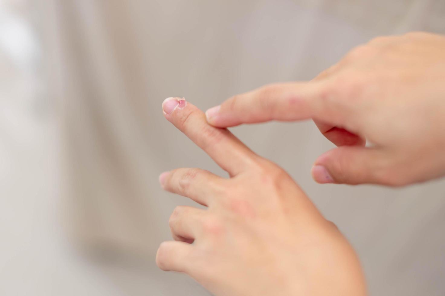Female hand pointing to dry, cracked skin on cuticles, skin is torn and