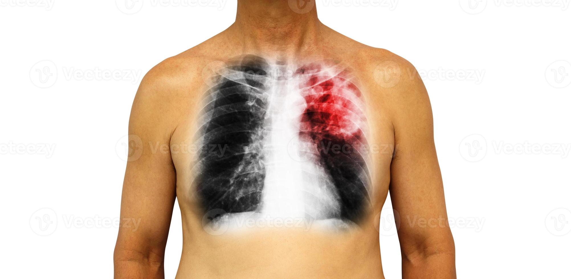 Pulmonary tuberculosis . Human chest with x-ray show patchy infiltrate left upper lung due to infection . Isolated background photo