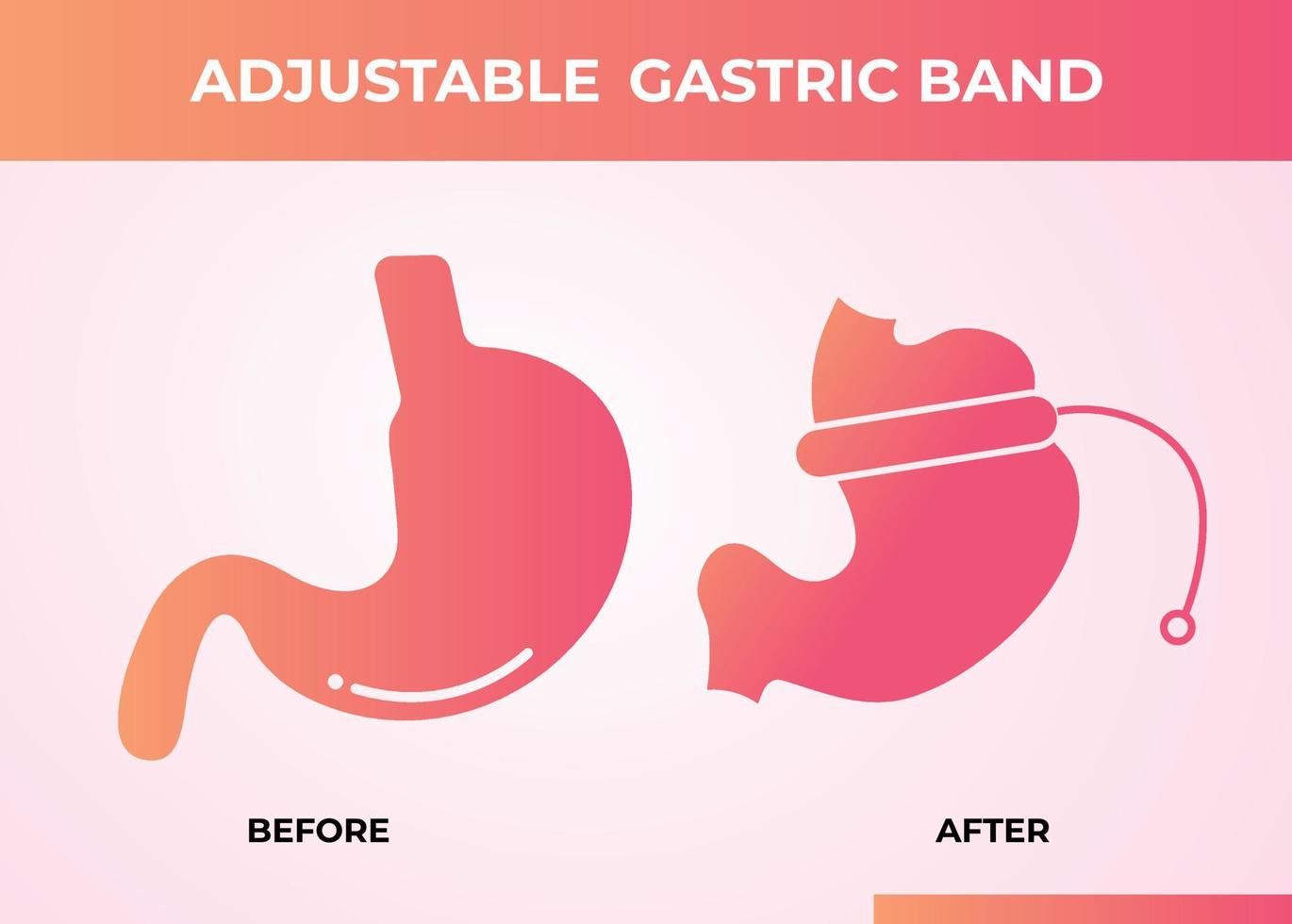 Illustration of Adjustable Gastric Band devise Weight Loss Surgery vector