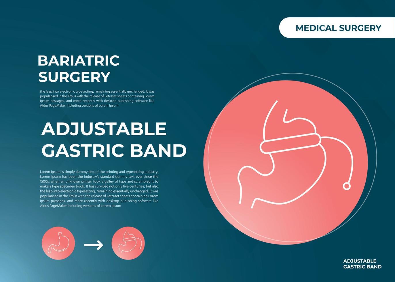 Illustration of Adjustable Gastric Band devise Weight Loss Surgery vector