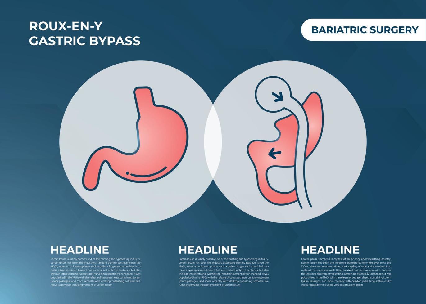 Roux en Y Gastric Bypass RNY Weight Loss Surgery vector illustration icon