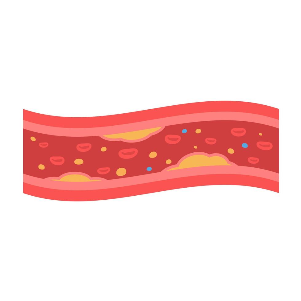 coronary arteries with accumulated fat in the body vector