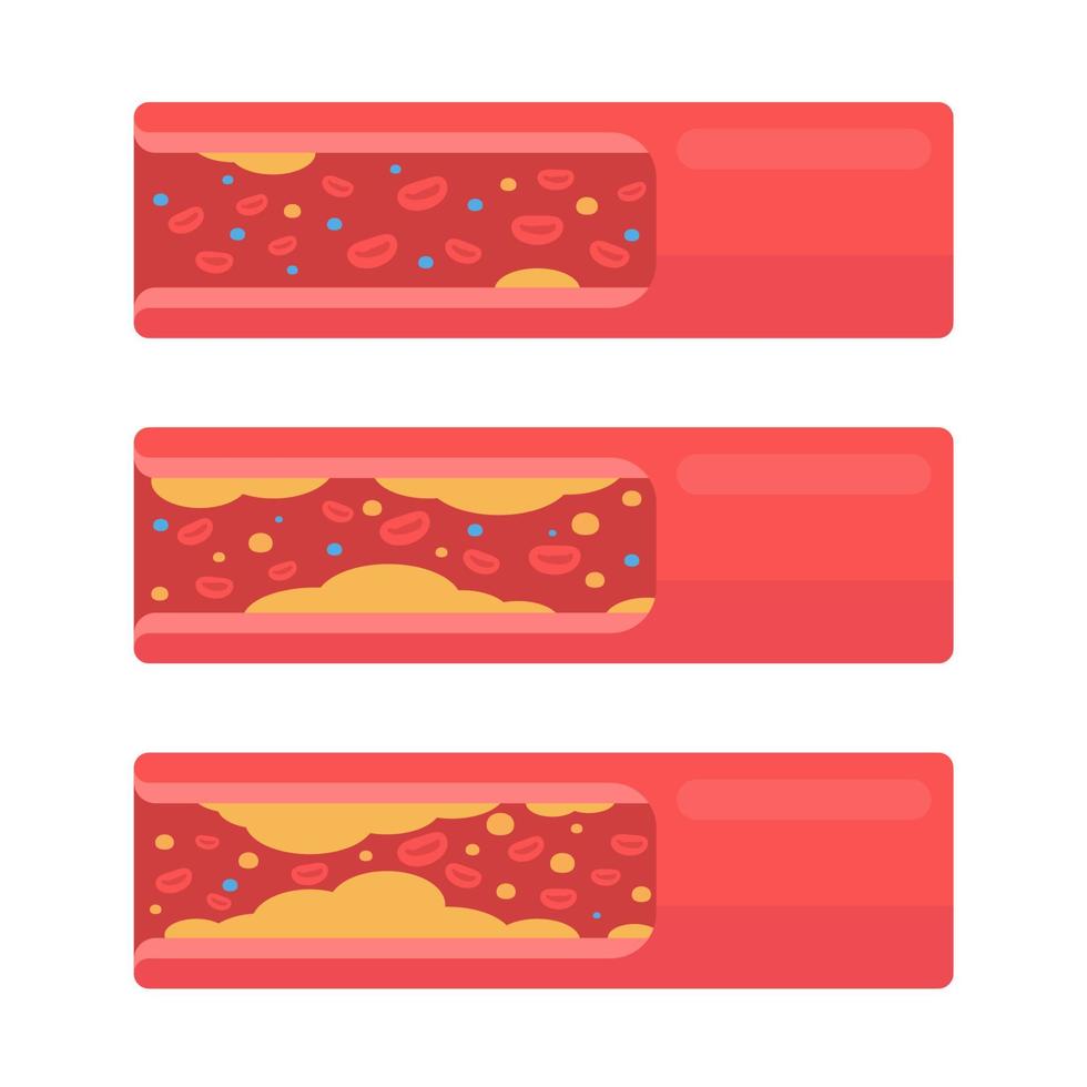 coronary arteries with accumulated fat in the body vector