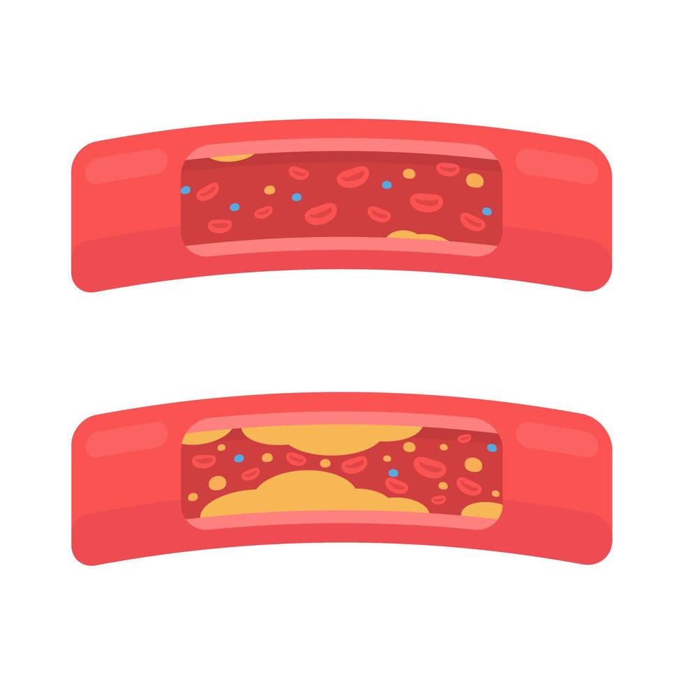 coronary arteries with accumulated fat in the body vector
