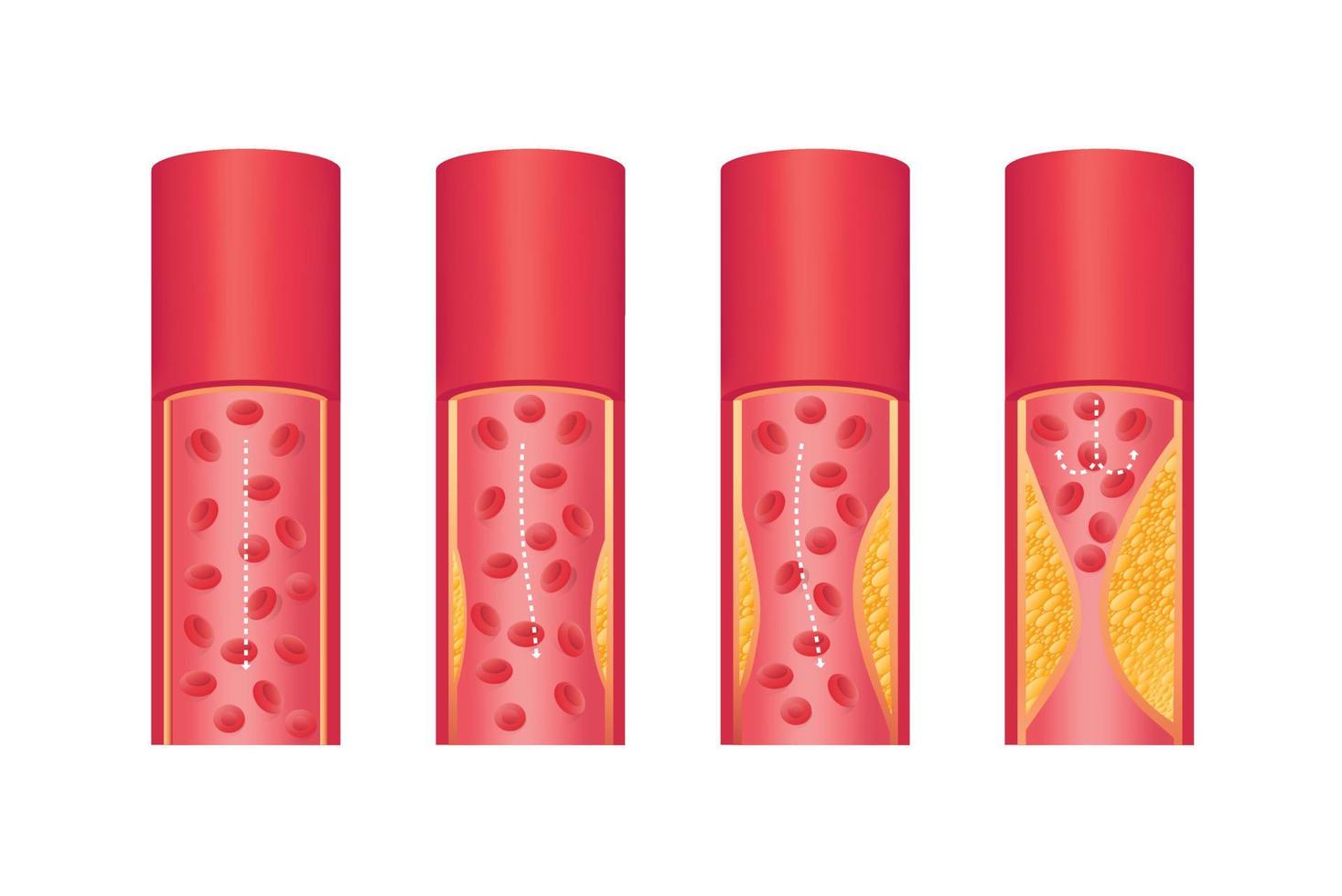 la estructura del interior de las arterias. enfermedad de aterosclerosis. vector