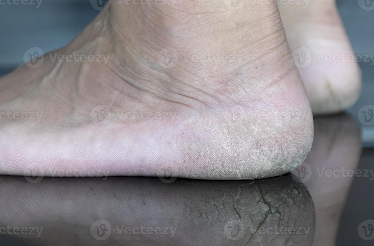 Close up cracked heel further deep cracks and dry flaky skin photo