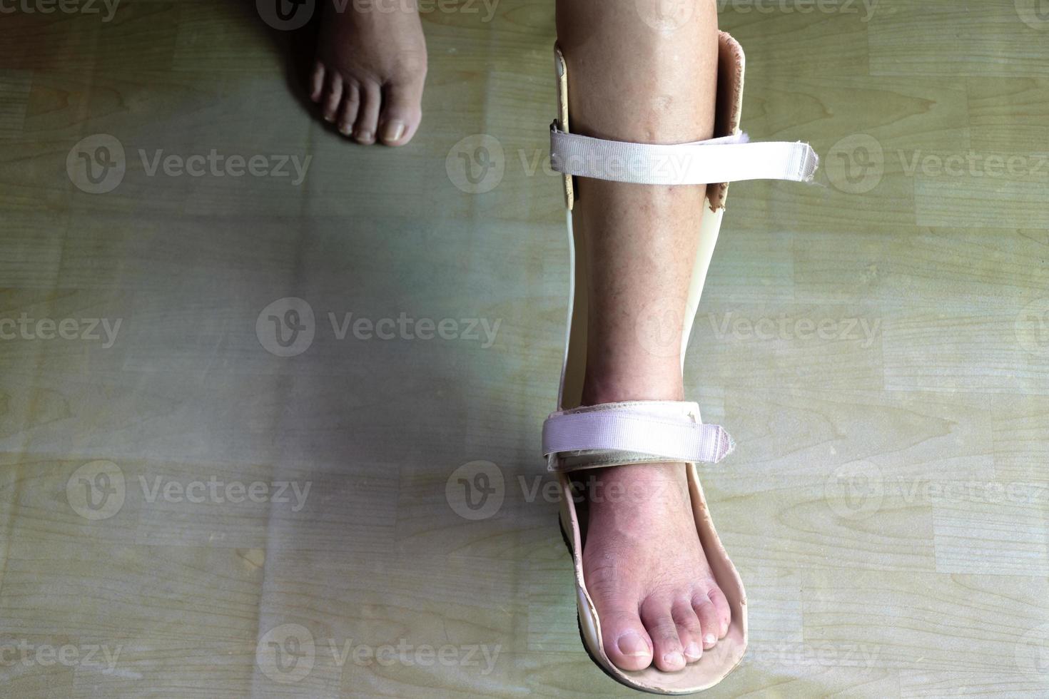 Foot splint for treatment photo