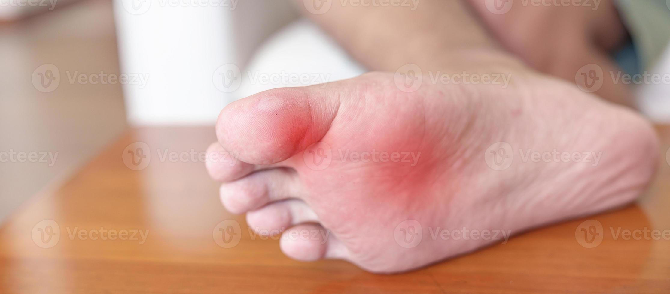 hombre que tiene juanetes en los dedos de los pies o ampollas debido al uso de zapatos estrechos y al despertar o correr durante mucho tiempo, dolor descalzo debido a la fascitis plantar. salud y concepto médico foto