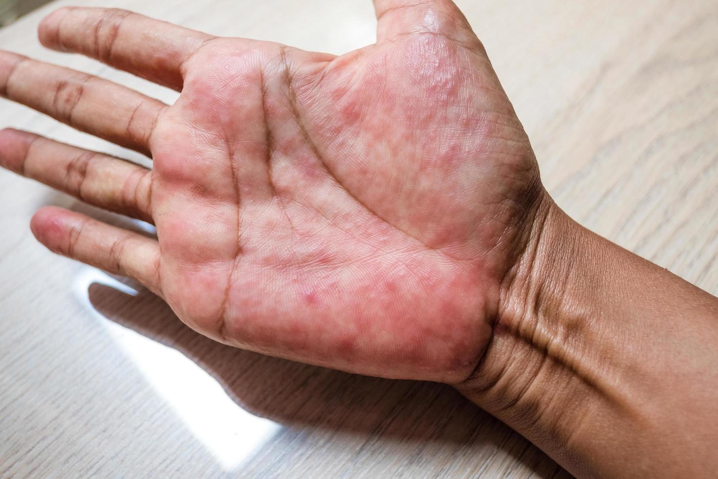 erupción roja en las manos de las palmas y otras enfermedades virales infecciosas en niños y adultos foto