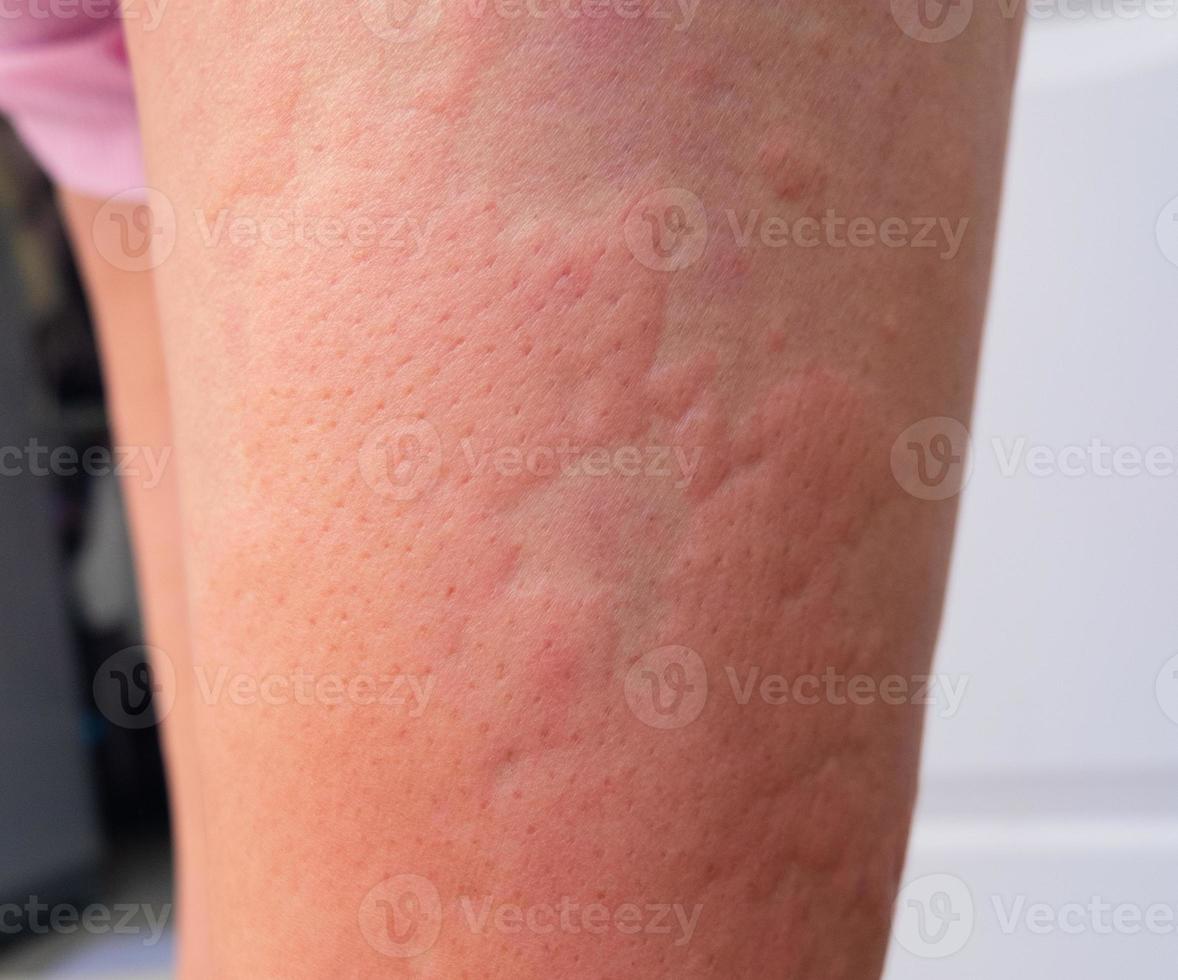 allergy rash of dermatitis problem. skin problem from drug allergy. 14939418 Stock Photo at Vecteezy