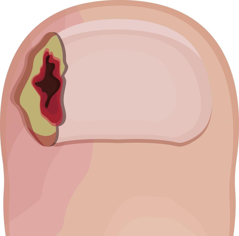 ingrown toenail isolated on white background vector