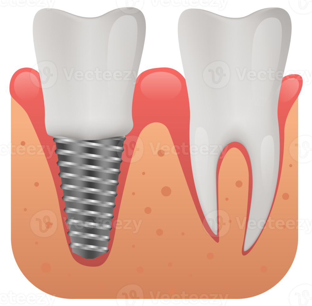 dentale impiantare struttura, umano denti e dentale impiantare png