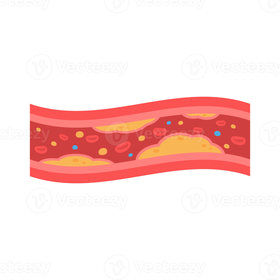coronary arteries with accumulated fat in the body png
