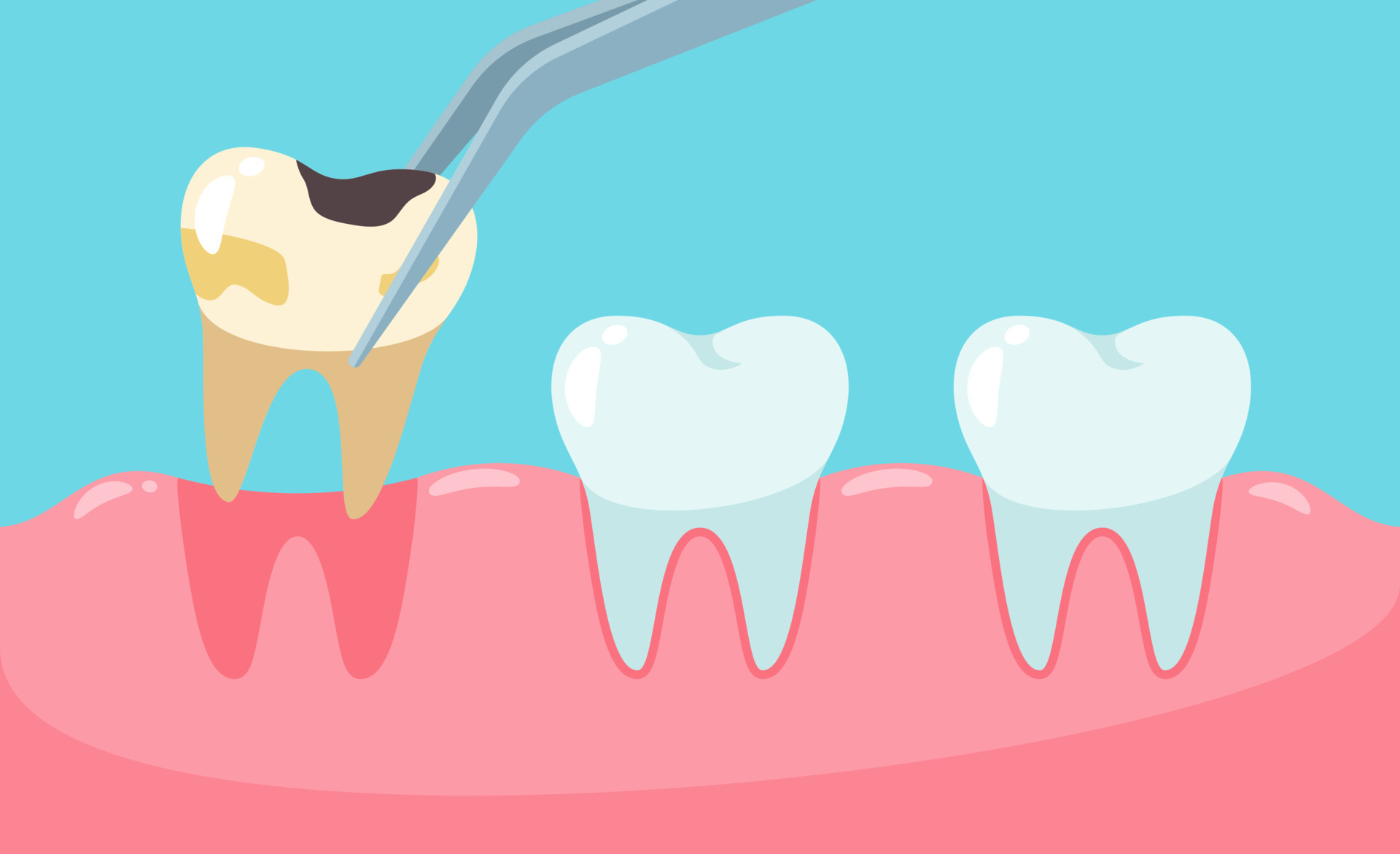 Pencabutan gigi berlubang vektor. gigi tidak sehat. 15159458 Vector Art