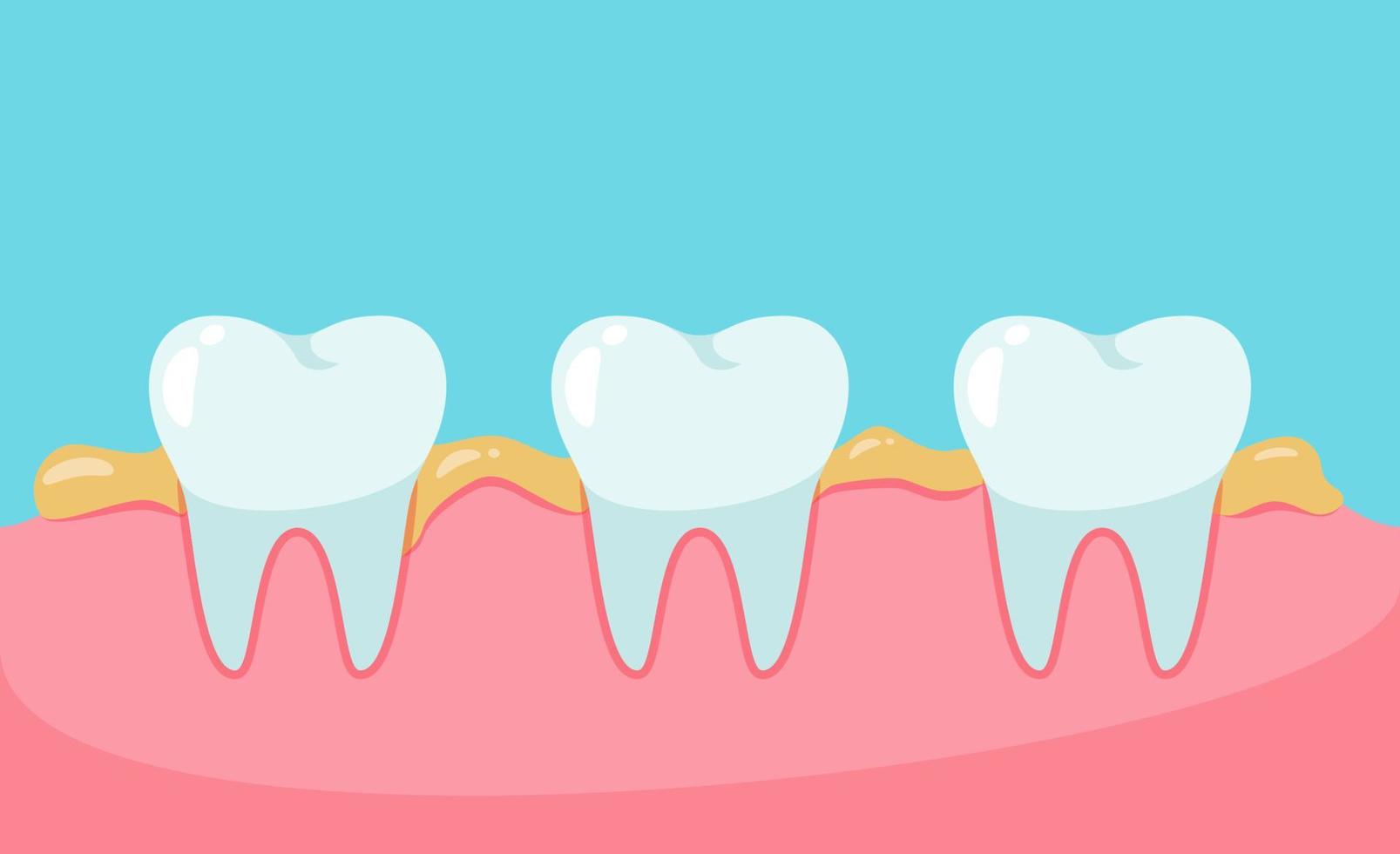 Dental plaque or tartar vector. vector teeth and gums.