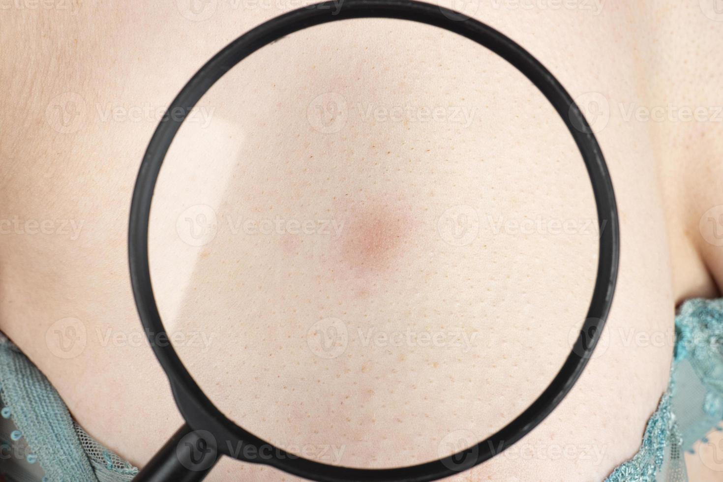 rash red spot on female breast, doctor examination on breast cancer closeup photo