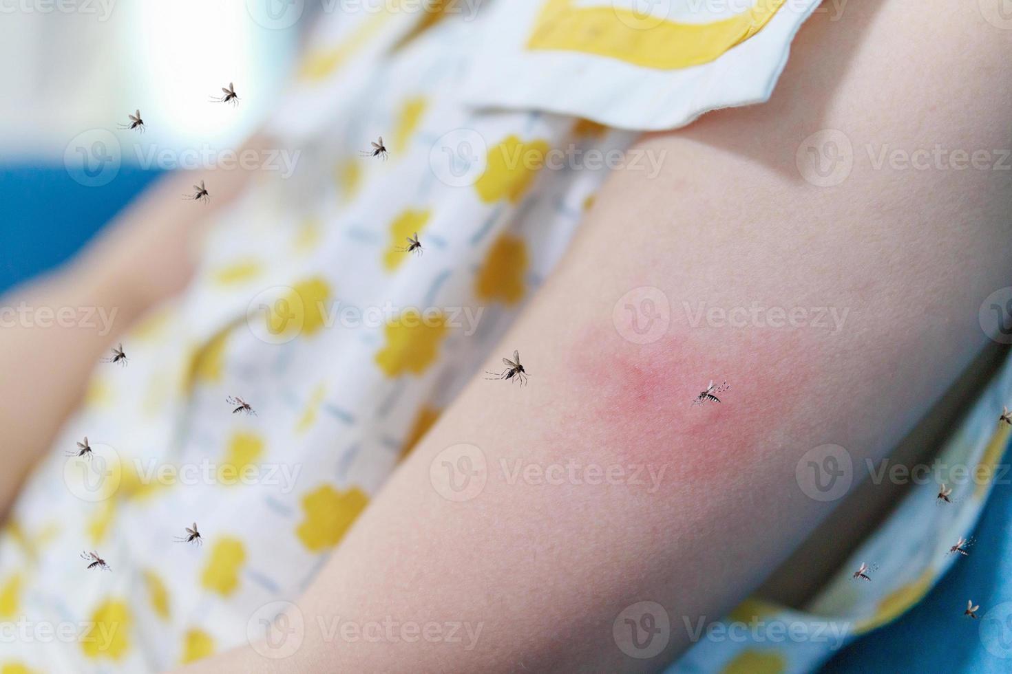 la niña tiene alergia a la erupción cutánea y le pica el brazo por la picadura de un mosquito foto