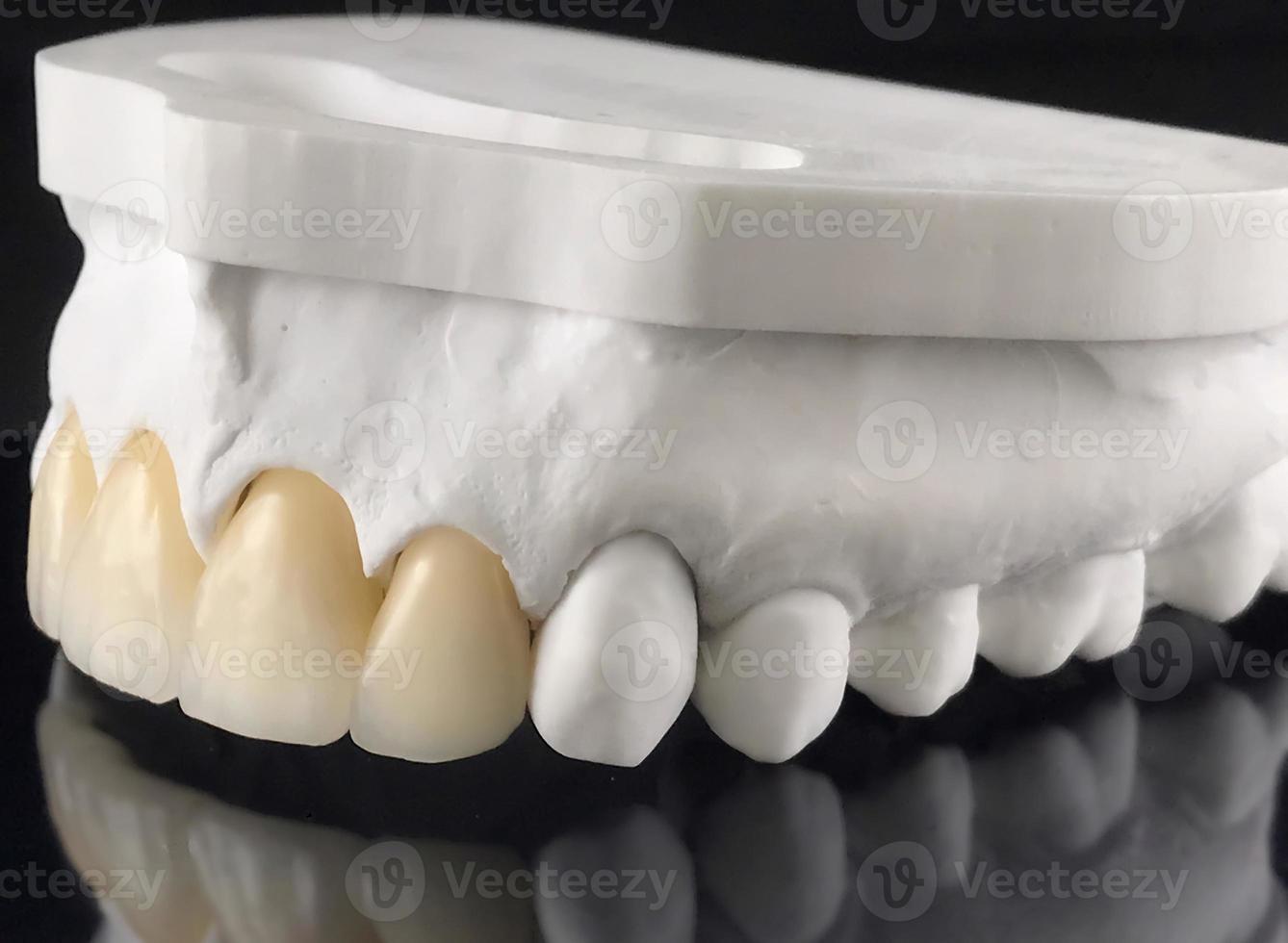 Close-up of dental prosthesis porcelain teeth in a mold. Dental technician working in a ceramic crowns. Technical shots of tooth prosthesis and model on a dental prosthetic laboratory. photo